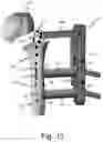 Fig. 09 - Proximal humeral stabilization systems and methods thereof