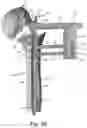 Fig. 22 - Proximal humeral stabilization systems and methods thereof
