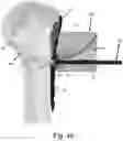 Fig. 28 - Proximal humeral stabilization systems and methods thereof