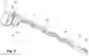 Fig. 04 - Implant for Bone Fixation