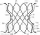 Fig. 01 - Methods for docking a heart valve