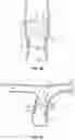 Fig. 08 - Methods for docking a heart valve