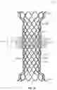 Fig. 33 - Methods for docking a heart valve