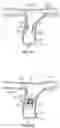 Fig. 35 - Methods for docking a heart valve