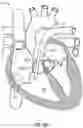 Fig. 40 - Methods for docking a heart valve