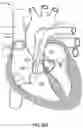 Fig. 46 - Methods for docking a heart valve