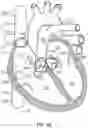 Fig. 02 - Devices and systems for docking a heart valve