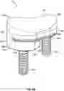 Fig. 10 - Glenoid implant systems and methods of using the same