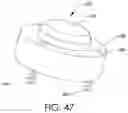 Fig. 49 - Adjustable implant and method of use