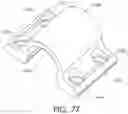 Fig. 79 - Adjustable implant and method of use