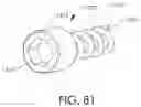 Fig. 85 - Adjustable implant and method of use