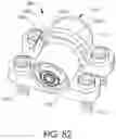 Fig. 86 - Adjustable implant and method of use