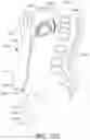 Fig. 98 - Adjustable implant and method of use