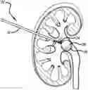 Fig. 01 - Urine Collecting System Interventions For Improving Kidney Function