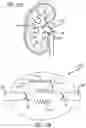 Fig. 10 - Urine Collecting System Interventions For Improving Kidney Function