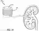 Fig. 11 - Urine Collecting System Interventions For Improving Kidney Function