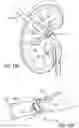Fig. 13 - Urine Collecting System Interventions For Improving Kidney Function