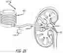 Fig. 19 - Urine Collecting System Interventions For Improving Kidney Function