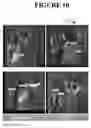 Fig. 11 - Methods of treating disorders using CSF1R inhibitors