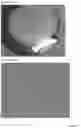 Fig. 18 - INTRAOCULAR LENS COMPOSITIONS