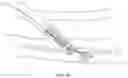 Fig. 19 - Endovascular implants and devices and methods for accurate placement