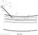 Fig. 33 - Endovascular implants and devices and methods for accurate placement