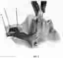 Fig. 02 - LARYNGEAL MASK