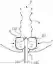 Fig. 01 - CONTROL OF BALLOON SIZE IN BOWEL IRRIGATION SYSTEM