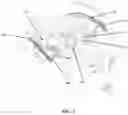 Fig. 02 - Visual prosthesis employing ventricular or endovascular neural electrode arrays