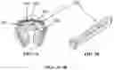 Fig. 04 - Visual prosthesis employing ventricular or endovascular neural electrode arrays