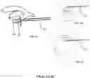 Fig. 07 - Visual prosthesis employing ventricular or endovascular neural electrode arrays