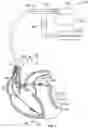 Fig. 02 - Method and device for avoiding competitive atrial pacing