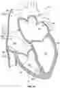 Fig. 04 - Method and device for avoiding competitive atrial pacing