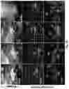 Fig. 10 - Use of Adipose-Derived Stem Cells for Glaucoma Treatment