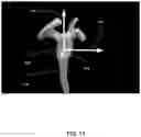 Fig. 12 - Pre-morbid characterization of anatomical object using statistical shape modeling (SSM)