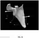 Fig. 11 - Pre-morbid characterization of anatomical object using statistical shape modeling (SSM)