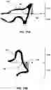 Fig. 16 - Pre-morbid characterization of anatomical object using statistical shape modeling (SSM)