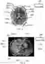Fig. 04 - METHODS AND APPARATUSES FOR DETERMINING TRANSDUCER LOCATIONS TO GENERATE TUMOR TREATING FIELDS