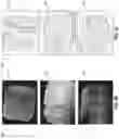 Fig. 07 - Intraoral scanning system with excess material removal based on machine learning