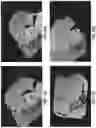 Fig. 19 - Intraoral scanning system with excess material removal based on machine learning
