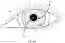 Fig. 10 - Coordinating an eye-mounted imager with an external camera