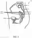 Fig. 06 - Devices and methods for fine-tuning alignment of charging device with implanted medical device