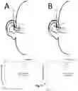 Fig. 09 - Audio processing device, system, use and method in which one of a plurality of coding schemes for distributing pulses to an electrode array is selected based on characteristics of incoming sound