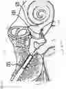Fig. 27 - TRANSDUCER PLACEMENT FOR GROWTH ACCOMMODATION