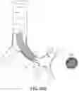 Fig. 45 - LUNG ACCESS DEVICE