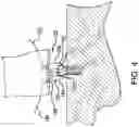Fig. 04 - Adjustable all-suture anchoring assembly and method