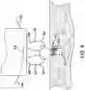 Fig. 07 - Adjustable all-suture anchoring assembly and method