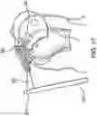 Fig. 16 - Adjustable all-suture anchoring assembly and method
