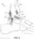 Fig. 03 - EXTRA JOINT STABILIZATION CONSTRUCT