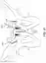 Fig. 12 - EXTRA JOINT STABILIZATION CONSTRUCT